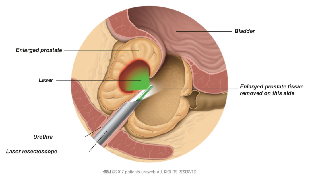 Brazilian prostate