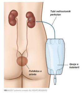 Fig. 2a: tubi nefrostomik perkutan është përdor për të zbrazur direkt urinën nga veshka në qesen e kateterit.
