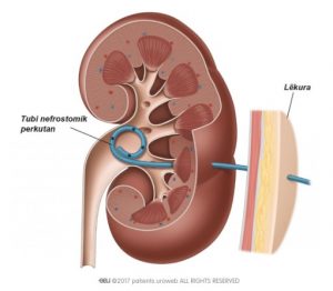 Fig. 2b: Tubi nefrostomik perkutan brenda veshkës.