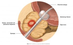 Фиг. 3: При фокалната терапия туморните клетки в простатата се атакуват директно и така не се увреждат сериозно други тъкани.