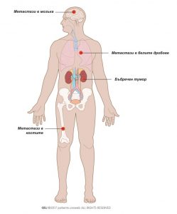 Фиг. 5: Бъбречен тумор с метастази може да се разпространи към белите дробове, костите и мозъка.