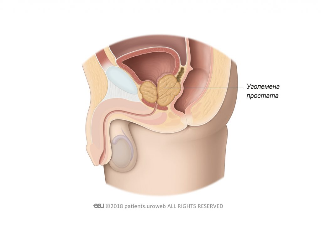 Фиг. 1б: Уголемена простата, притискаща уретрата и пикочния мехур.