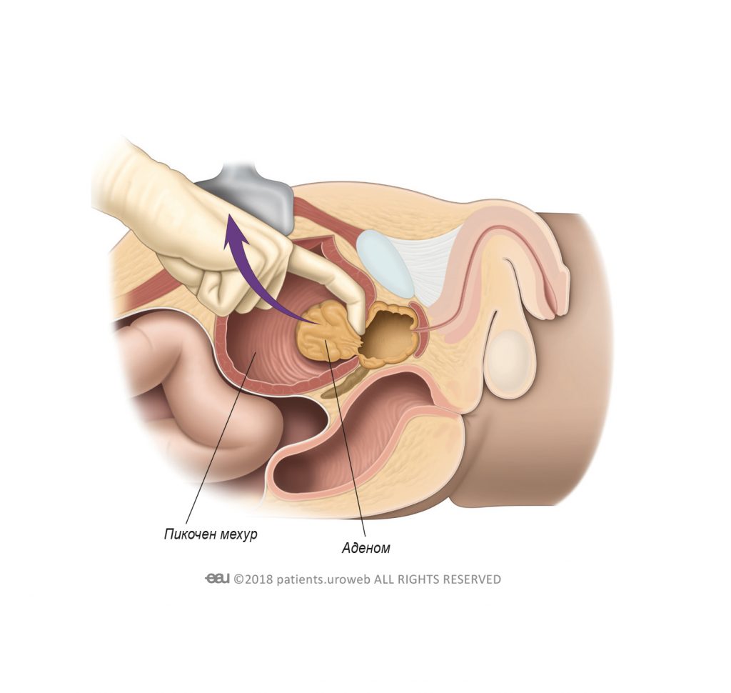 Фиг. 1: Хирургът премахва аденома по време на отворена простатектомия.