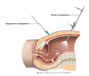 Фиг. 3: При лапароскопска операция хирургът поставя хирургичните инструменти в корема.