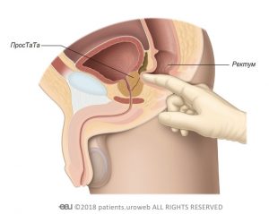 Фиг. 1: Дигитален преглед на ректума, за да се установи размер, форма и състояние на простатата.