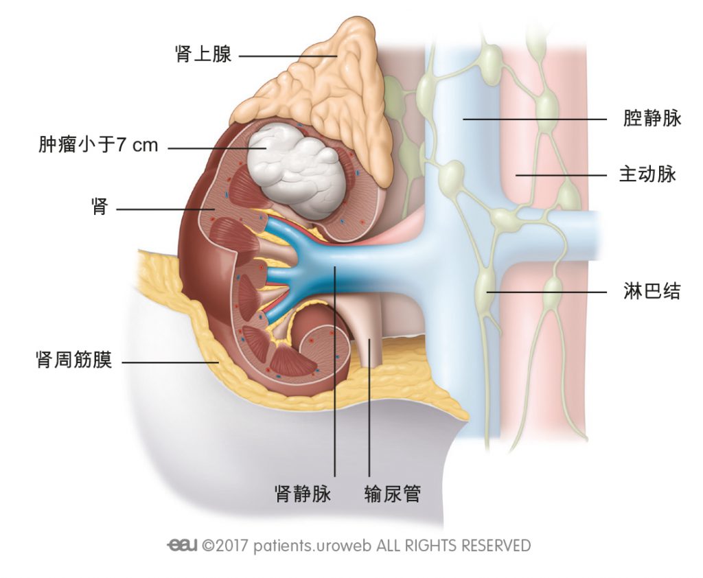 图 1: I期肾肿瘤小于7 cm，局限于肾内。