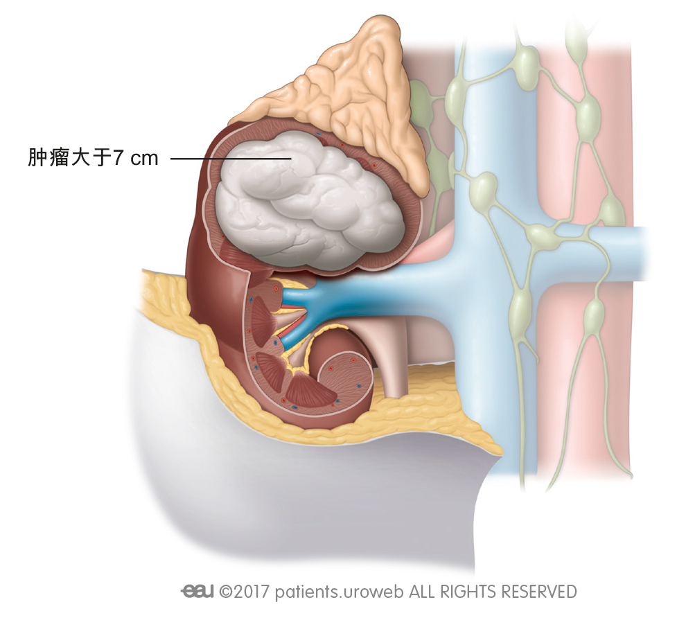 图 2: II期肿瘤局限于肾内，肿瘤大于7 cm。