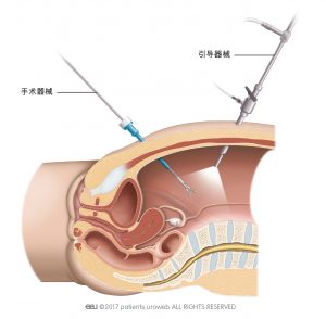 图2. 在腹腔镜手术中，外科医生通过腹壁上的小切口插入手术器械。