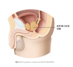 图2 体积增大的前列腺挤压尿道和膀胱。