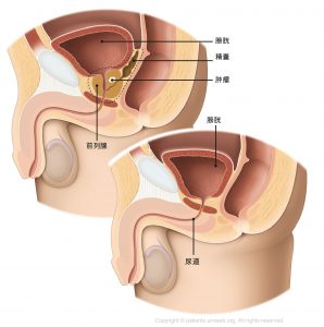 图1:在根治性前列腺切除术中，外科医生切除整个前列腺和精囊。
