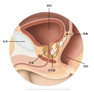 图1. 已扩散至精囊的T3期前列腺肿瘤。