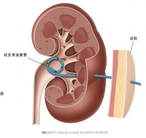 图2 a和 b: 用经皮肾造瘘管直接引流肾内的尿液。