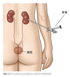 图 1a:用肾镜将结石直接从肾内取出。