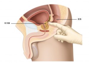图1：通过直肠指检去了解前列腺的大小、形状和质地。