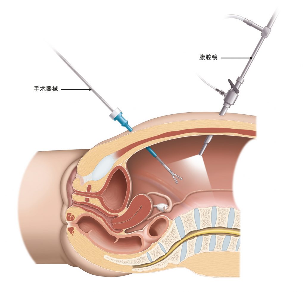图2：在腹腔镜手术中，外科医生通过腹部的小切口插入手术器械。
