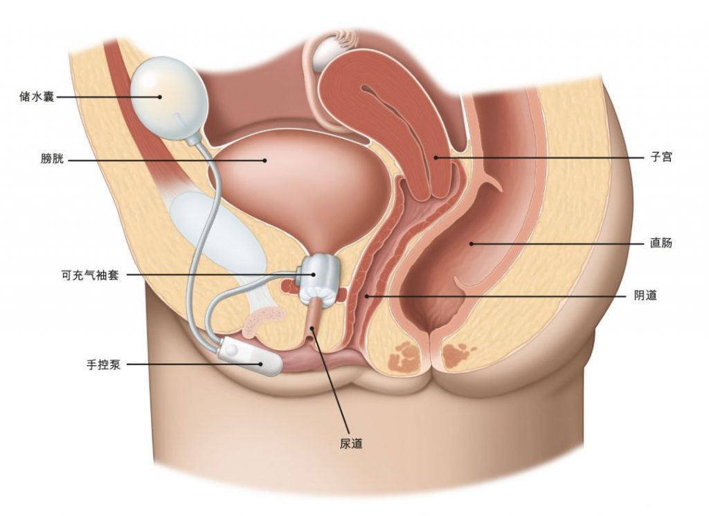 图1：在Burch膀胱颈悬吊术中，辅助缝线提拉膀胱颈。