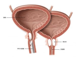 图.1将填充剂注射到尿道壁。