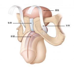图1：耻骨后两臂吊带的一种常见类型。