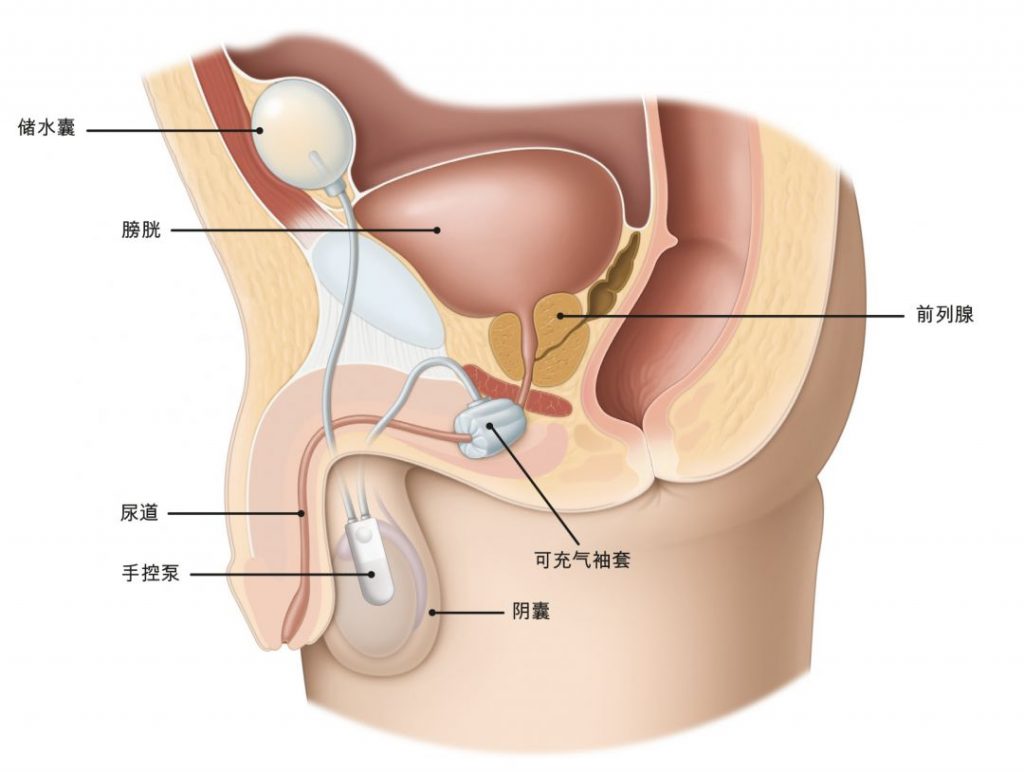 图1：男性下尿路人工尿道括约肌植入术。