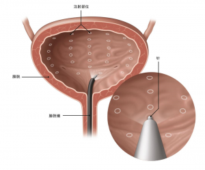 图1：将肉毒杆菌毒素注入膀胱壁。