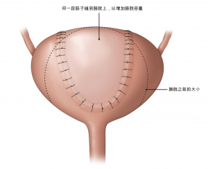 图1：增加膀胱容量的膀胱手术。
