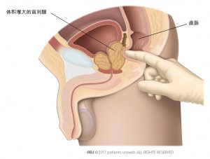 图1：直肠指检，以摸清前列腺的大小、形状和质地。