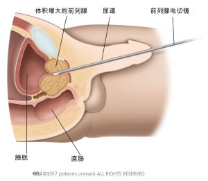 图1 通过尿道进行手术操作。