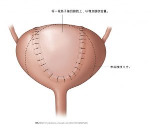 图2.扩大膀胱容量的膀胱手术。