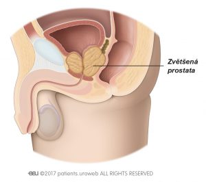 Obr. 2: Zvětšená prostata utlačující močovou trubici a měchýř