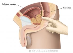 Obr. 1: Vyšetření per rectum ke zhodnocení velikosti, tvaru a struktury prostaty.