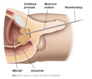 Obr. 1: Operace přes močovou trubici.