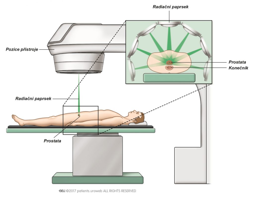 Obr. 1: Zevní radioterapie se užívá k poškození a zabití nádorových buněk.