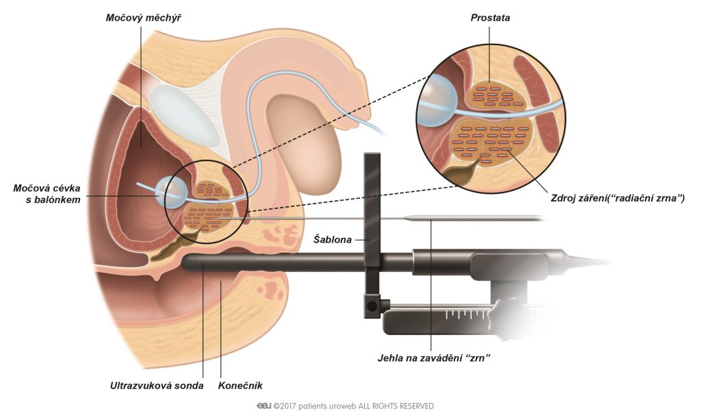 radioterapie prostata tratament naturist pentru calcifiere prostata