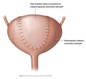 Obr. 4: Operace močového měchýře ke zvětšní objemu močového měchýře.