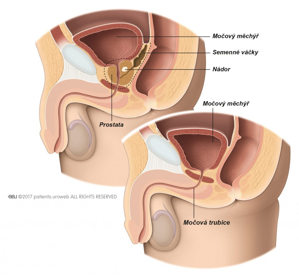 Obr. 1: Při radikální prostatektomii chirurg odstraní celou prostatu a semenné váčky.