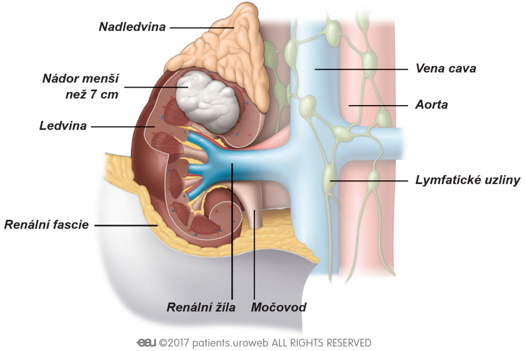 Obr. 1: Stage I (stadium I) tumoru ledviny je nádor do 7 cm, omezen na ledvinu.