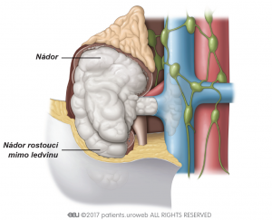 Obr. 3: Stádium III – nádory se rozšířily do renální žíly, tukové tkáně v okolí ledviny (perirenálního tuku) nebo do vena cava.