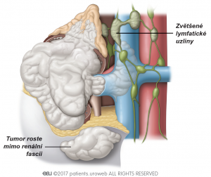 Obr. 4: Stádium IV – nádory se rozšířily mimo ledvinu za renální fascii a do nadledvin. V této fázi je někdy postižena jedna nebo více lymfatických uzlin.