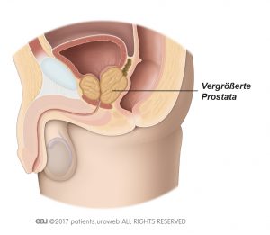 Abb. 2: Eine vergrößerte Prostata drückt Harnröhre und Harnblase zusammen.
