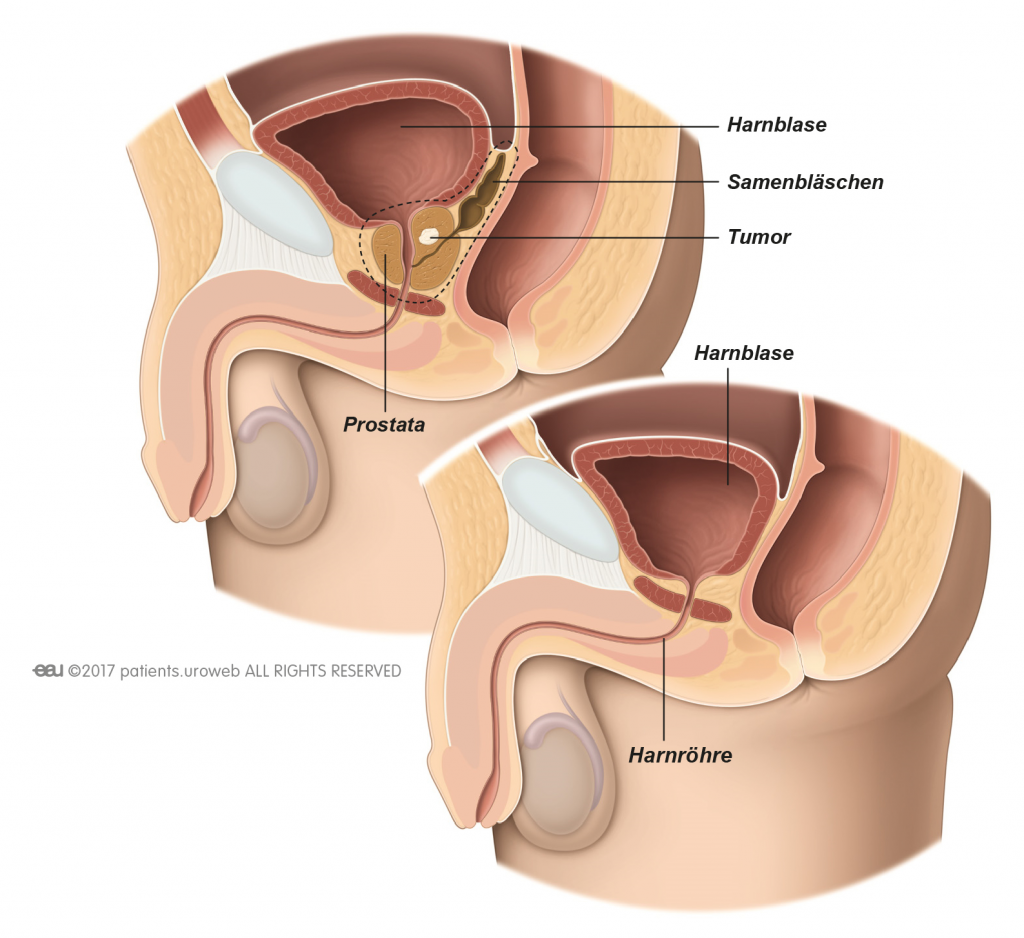 prostata tumor entfernen