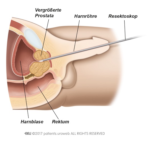 prostata ausschälung laser prostatita cum să tratezi o tumoare