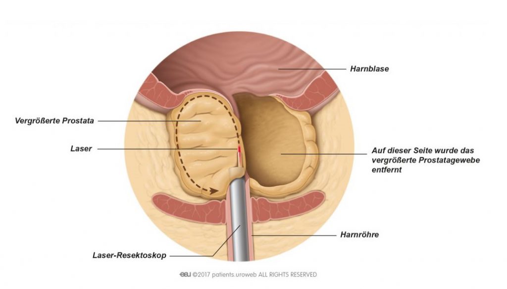 prostata adenom enukleation