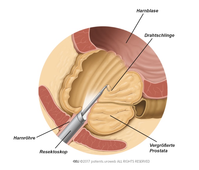 Samenerguß kein prostata nach op Prostatavergrößerung, Ejakulat