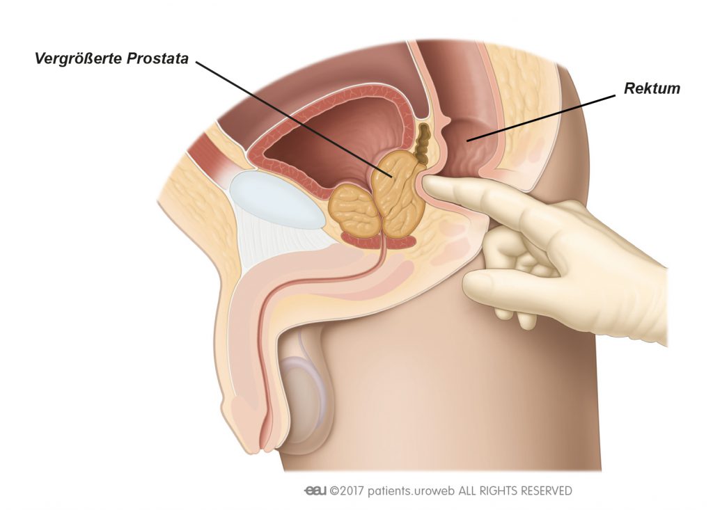 prostata flüssigkeit tritt aus)