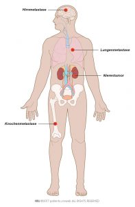 Abb. 1: Ein metastasierender Nierenkrebs kann sich in Lungen, Knochen oder Gehirn ausbreiten.