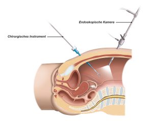 Abb. 3: Bei einer laparoskopischen Operation führt der Chirurg seine Instrumente durch kleine Schnitte in die Bauchhöhle ein.