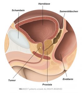 Abb. 1: Ein T1-Prostatatumor ist zu klein, um bei der Tastuntersuchung gefühlt oder auf einer Aufnahme gesehen zu werden.