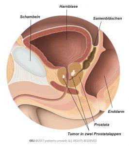 Abb. 2: Ein T2-Prostatatumor ist auf die Prostata beschränkt.