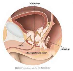 Abb. 2: Ein T4-Prostatatumor, der sich auf den Blasenhals, den Blasenschließmuskel und das Rektum ausgebreitet hat.