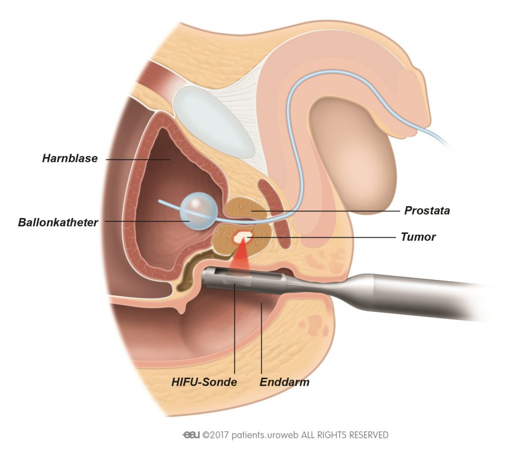 prostatakrebs stufe 2